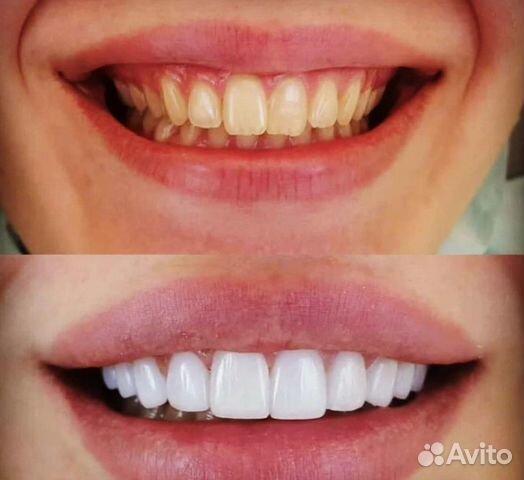Виниры Snap on Smile Виниры Snap on Smile