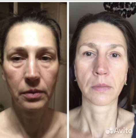 Массаж лица